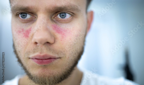 man suffers from systemic lupus erythematosus, age spots of redness on the face, a rash. photo