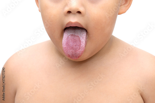 The little boy stuck out his tongue, showing signs of a white tongue. Caused by mold or bacteria photo