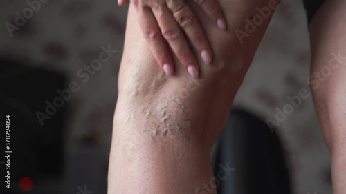 Varicose veins on woman legs indoors. Vascular health problem. Trombose on female legs photo