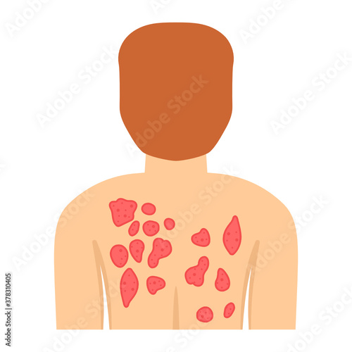 
Editable design of body rashes flat style 
