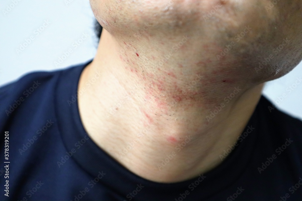髭剃り後の肌荒れに悩む日本人男性のクローズアップ 髭剃り後の肌荒れに悩む日本人男性のクローズアップ