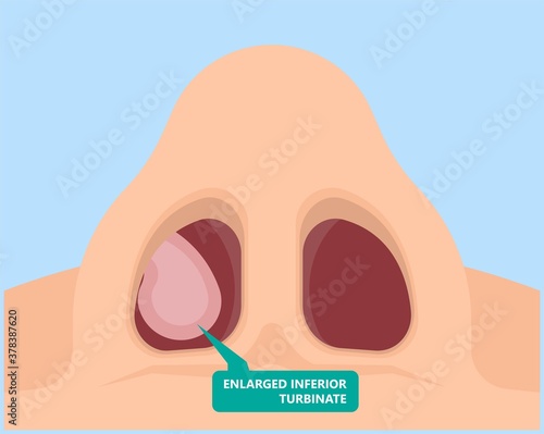 Turbinate hypertrophy ear ENT CPAP nose stop apnea block laser nasal RAVOR RFVTR runny sinus sleep treat airway concha device mucous polyps septal septum throat tissue airflow air way bullosa chronic