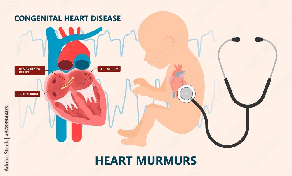 Fototapeta premium Cath Lab Atrial Septal Defect Tetralogy of Fallot Patent Foramen Ovale Mitral Valve Stenosis Heart Attack Ductus Arteriosus Doppler Coronary Artery Disease Congestive Congenital Valvular VSD exam leak
