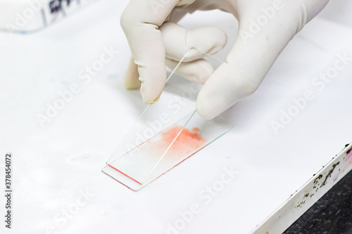 smear drawing of blood by glass slide