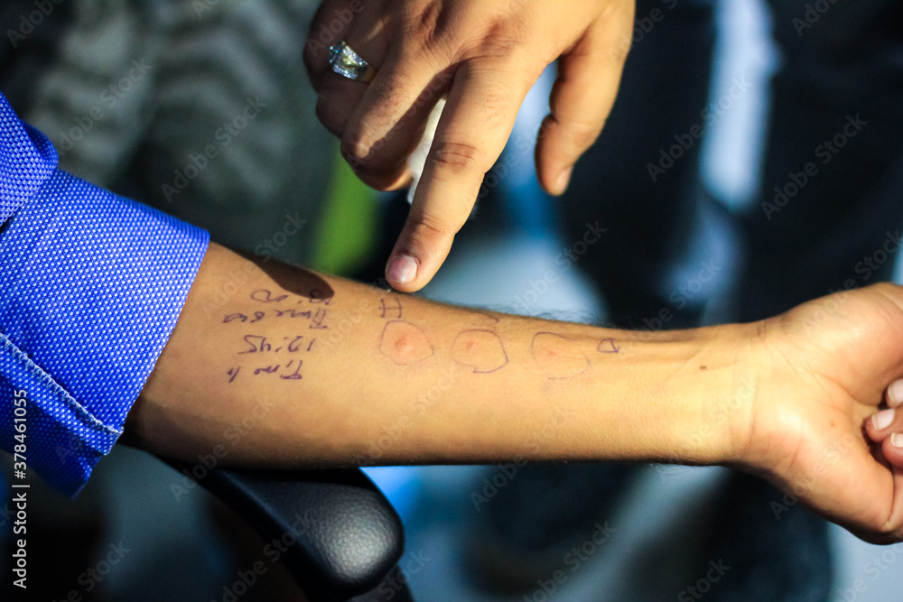 skin allergy test preparation by doctor on a patient hand showing the allergic hypersensitivity reaction wheal swelling