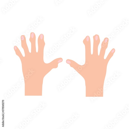 Arthritis is a disease of the human joints of the hands. Concept of medicine.