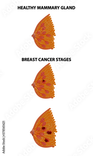 Breast cancer realistic vector illustration, medicine