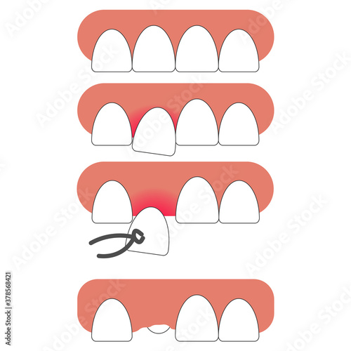 vector illustration of tooth extraction with medical instrument on white background. The emergence of new tooth in place of the extracted one. new tooth came out.