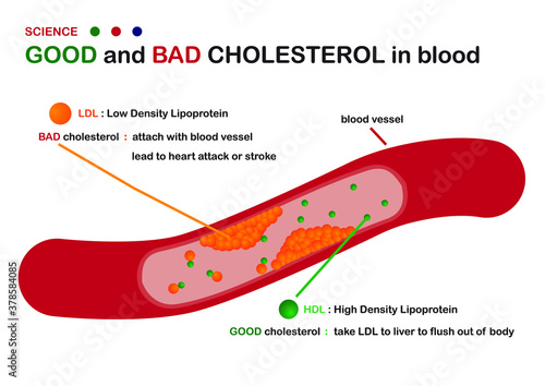 Science diagram show good and bad cholesterol (LDL and HDL) in blood vessel as plaque formation