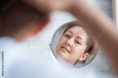 A woman with vitiligo looks in the mirror. Reflection in a table mirror a girl with a white spot on her forehead. Autoimmune disease. Lack of skin pigmentation.
