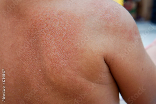 the skin on the back of the baby is red and peeling. asian baby. psoriasis. suitable for skin health purposes. shallow focus depth of field