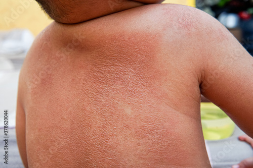 the skin on the back of the baby is red and peeling. asian baby. psoriasis. suitable for skin health purposes. shallow focus depth of field