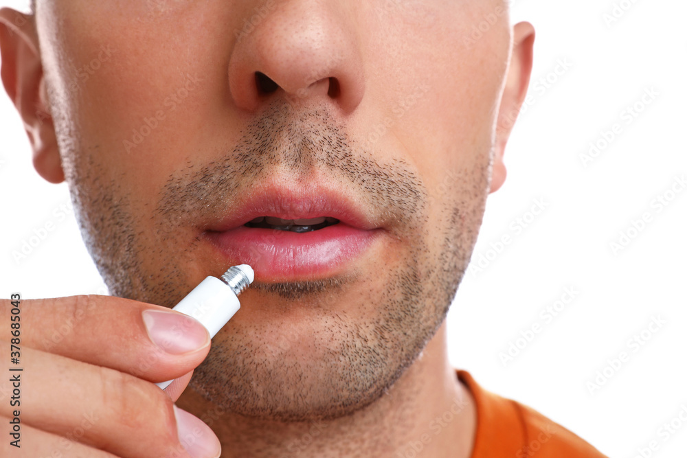 Naklejka premium Young man with cold sore applying cream on lips against white background, closeup