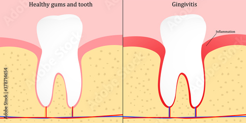 Gingivitis - gum disease. Vector illustration