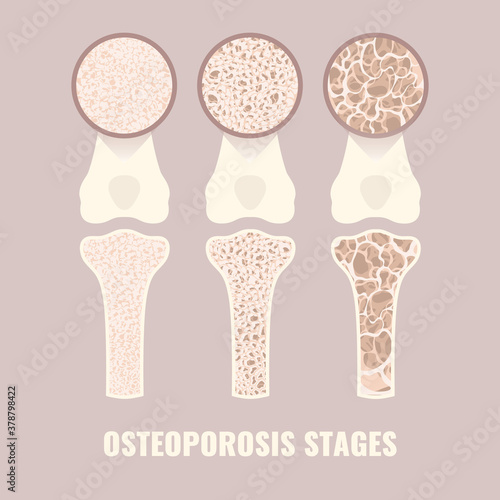 Osteoporosis disease stages from healthy to severe. Bone density loss infographic banner. Normal bone becoming osteoporotic bone. Skeletal system disease. Health care concept. Vector illustration.