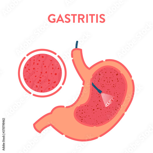 Gastroscopy procedure for stomach gastritis disease diagnostics. Gastrointestinal tract examination. Health care and medical concept. Vector illustration in flat style. Human body organ disorder. 