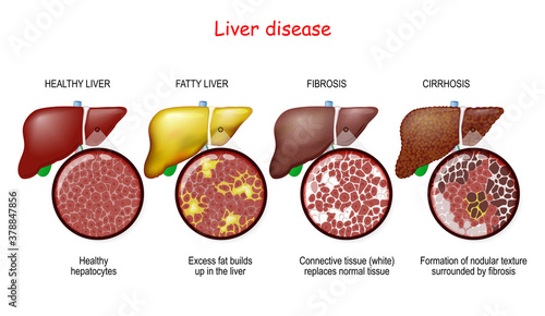 Liver diseases. Stages of liver damage photo