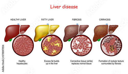 Liver diseases. Stages of liver damage