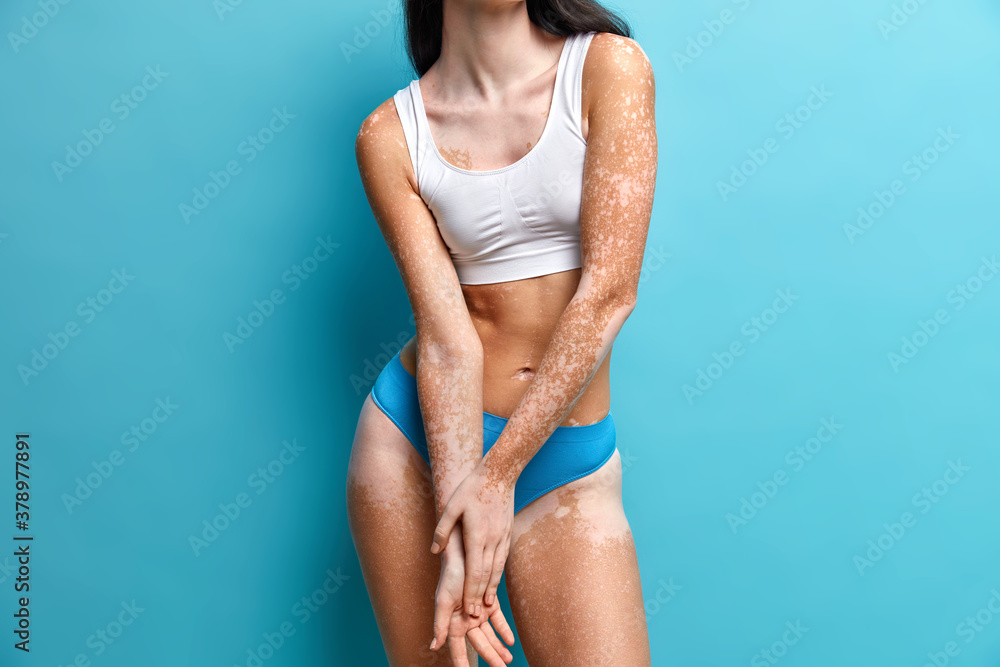 Φωτογραφία Indoor shot of slim female model with lack of skin pigmentation has vitiligo poses against blue background in underwear