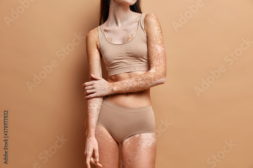 Fotografía Unrecognizable slim woman with vitiligo skin wears beige lingerie poses against brown background