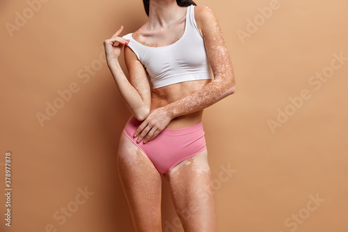 Different beauty standards. Cropped view of slim young female model with pale vitiligo spots on skin accepts herself as she is poses over beige wall in lingerie