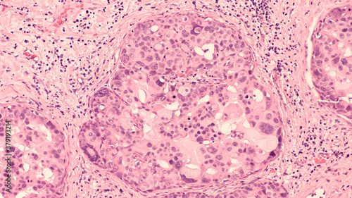 Canvastavla Breast biopsy photomicrograph of  ductal carcinoma in situ (DCIS), nuclear grade 3