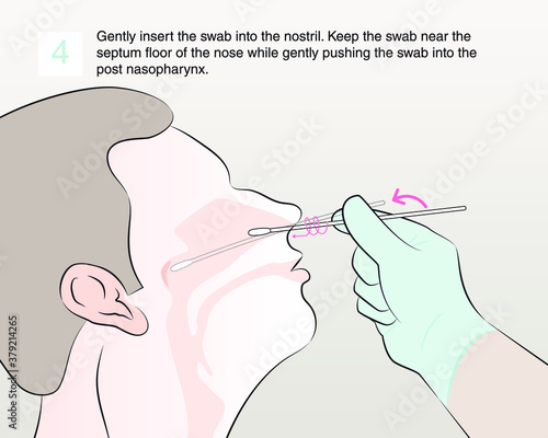 Step 4 : Gently insert the swab into the nostril. Keep the swab near the septum floor of the nose while gently pushing the swab into the post nasopharynx