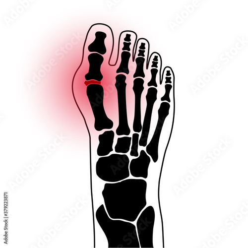 Arthritis foot concept