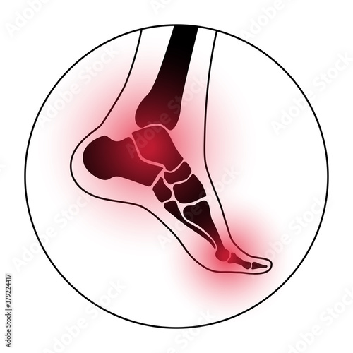 Arthritis foot concept