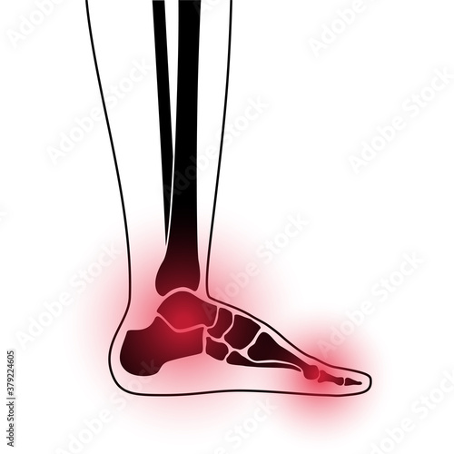 Arthritis foot concept