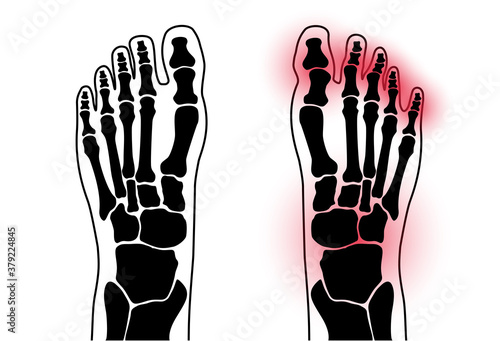 Arthritis foot concept