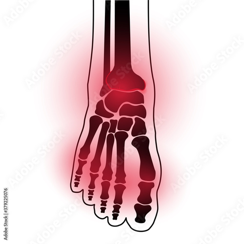 Arthritis foot concept