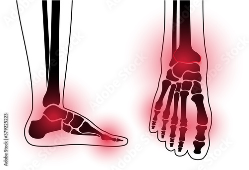 Arthritis foot concept
