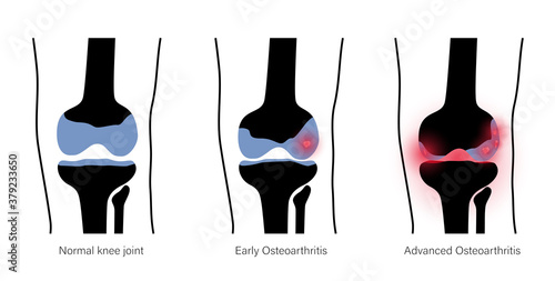 Arthritis in knee joint