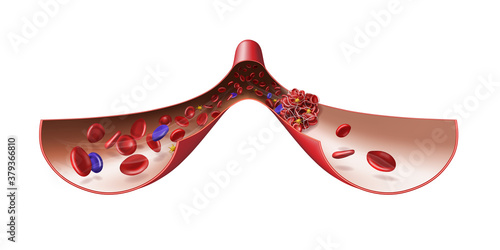 Normal vein and blood clot. Medical illustration. 3d vector