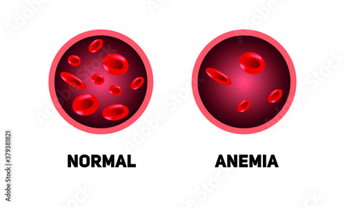 Anemia, the blood of a healthy person and a blood vessel in anemia.