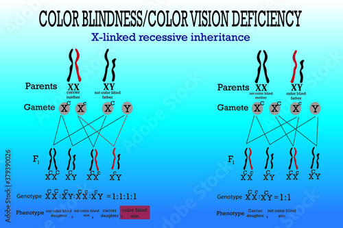 Color blindness genetics on X chromosome. X-linked gene  
