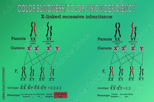 Color blindness genetics on X chromosome. X-linked gene  
