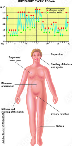 Illustration of a woman with a swollen body due to fluid retention caused by idiomatic edema, a list of the symptoms, and a graph showing the daily weight changes over a month, caused by the edema.