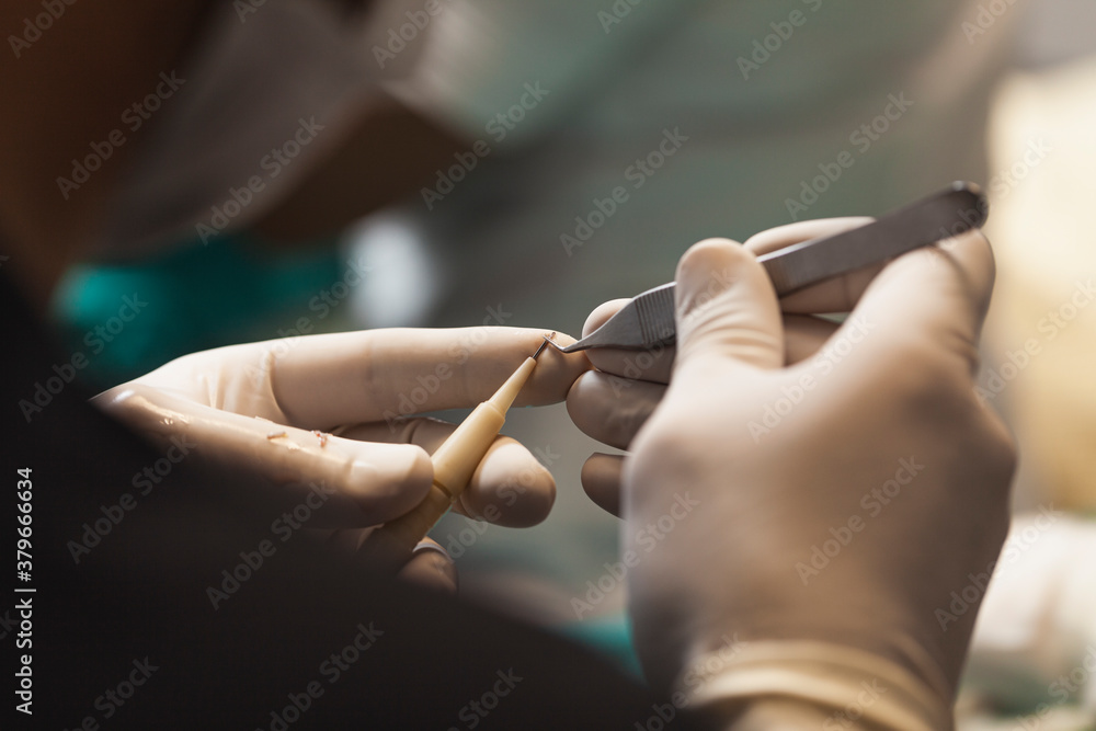 Ταπετσαρία Hair transplantation is a surgical technique that moves hair follicles from a pa
