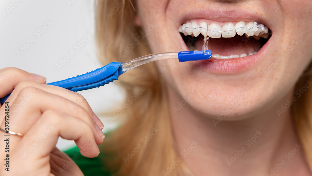 Close-up of a smiling woman face with braces on white teeth and toothbrush. Close-up of a smiling woman face with braces on white teeth and toothbrush.