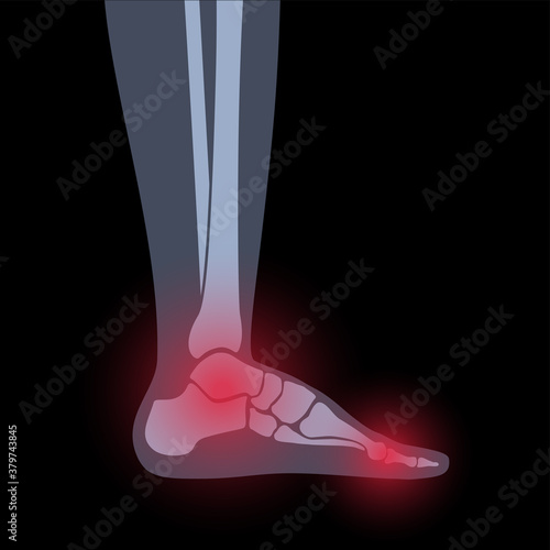 Arthritis foot concept