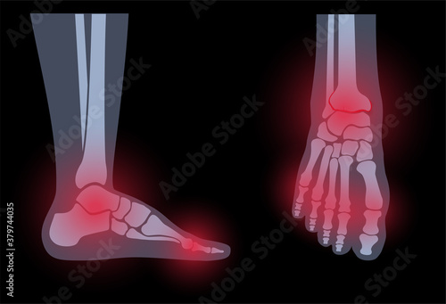 Arthritis foot concept