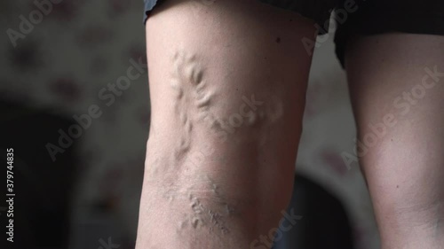 Varicose veins on woman legs indoors. Vascular health problem. Trombose on female legs photo