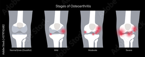 Arthritis in knee joint
