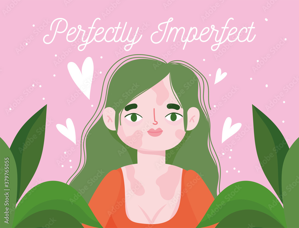 perfectly imperfect, cartoon woman with pigmentation disease perfectly imperfect, cartoon woman with pigmentation disease