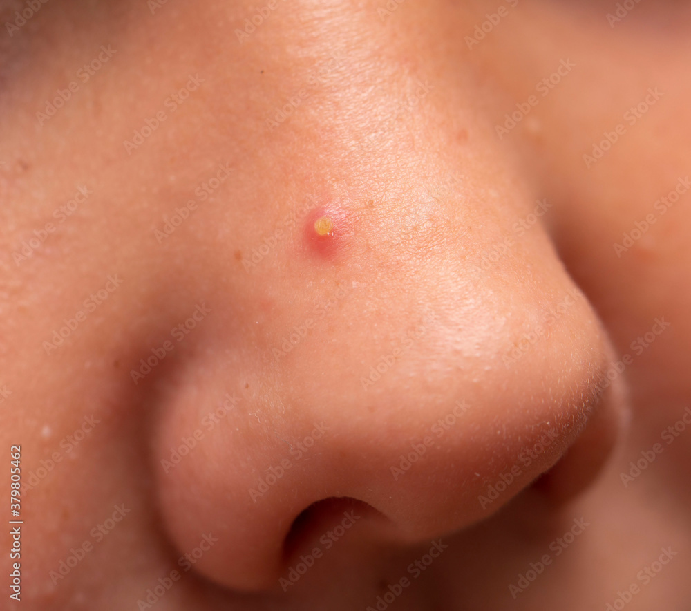 Fototapeta premium inflamed acne on the nose
