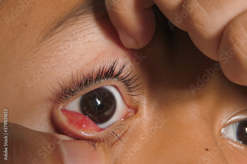 little boy shows a chalazion (stye) on the eyelid during Blepharitis examine ,closeup. Ablation,Glaucoma selective focus. photo