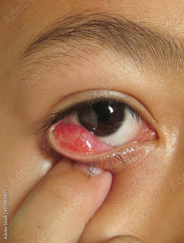 inner view of nodule shaped style- chalazion on the lower eyelid of child. Papilledema ,Blepharitis selective focus.   photo