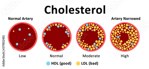 Cholesterol in artery, health risk. The accumulation of cholesterol in the blood vessels. Atherosclerosis of blood vessels. Cholesterol in the arteries. HDL or LDL . Vector medical blood flow sign.
